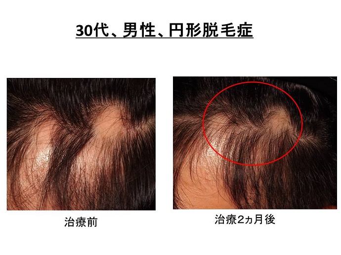 円形脱毛症　病院